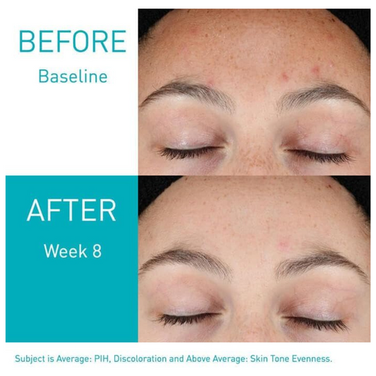 CeraVe Retinol Serum for Post-Acne Marks and Skin Texture | Pore Refining, Resurfacing, Brightening Facial Serum #BrightEyes #WrinkleCare #CaffeineBoost #EyeCreamEssentials #PeptidePower #AntiAgingSkincare #YouthfulGlow #SmoothSkin #TiredEyes #UnderEyeCare